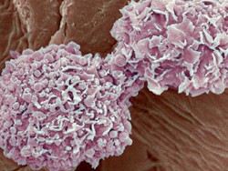 Kanker Payudara Serang Pria di Irlandia Utara