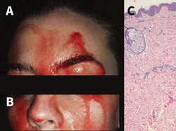 Kondisi Langka Membuat Wanita Ini Mengeluarkan Keringat Darah