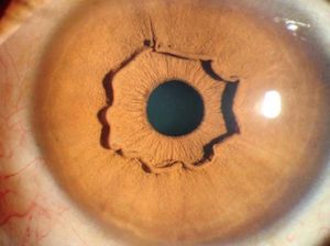 Cedera Mata Unik: Dari Kornea yang Meleleh Hingga Ada Cacingnya