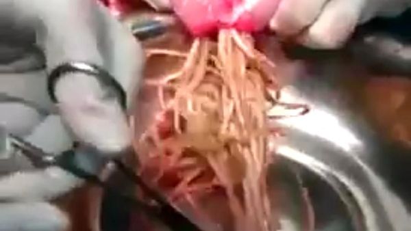 Potret Cacing Parasit yang Sering Dikira Mi dan Menyumbat Usus
