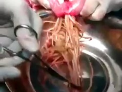 Isu Hoax Banyak Makan Mi Sebabkan Penyumbatan Usus