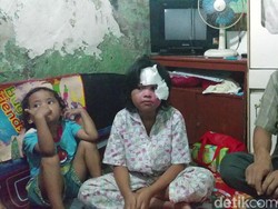 Ridwan Kamil Jamin Biaya Pendidikan Bocah Korban Minyak Panas