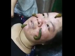 Ngeri, Wanita Ini Facial Wajah Pakai Lintah untuk Sedot Jerawat