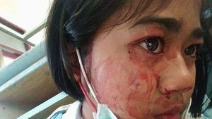 Orang-orang Berkondisi Langka yang Bisa Mengeluarkan Keringat Darah
