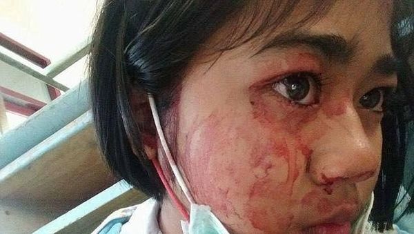 Orang-orang Berkondisi Langka yang Bisa Mengeluarkan Keringat Darah