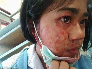 Orang-orang Berkondisi Langka yang Bisa Mengeluarkan Keringat Darah Orang-orang Berkondisi Langka yang Bisa Mengeluarkan Keringat Darah