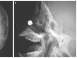 Dinding Hidung Bocah Ini Nyaris Bolong Karena Kemasukan Magnet
