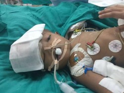 Bayi Kembar Siam yang Dipisahkan di India Akhirnya Membuka Mata