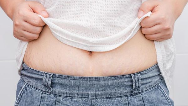Ini Dia Orang-orang yang Berisiko Memiliki Stretch Mark
