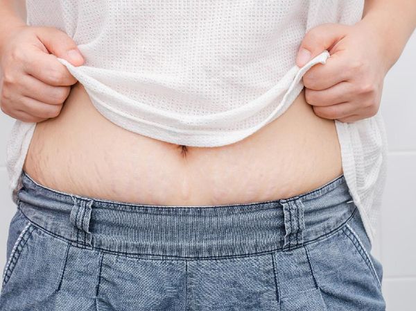 Ini Dia Orang-orang yang Berisiko Memiliki Stretch Mark