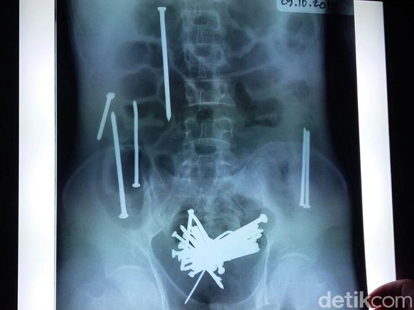 Ini Paku-paku yang Dimakan Wawan hingga Akhirnya Tewas