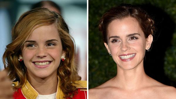 Tanpa Operasi Plastik, 10 Artis Ini Makin Cantik karena Perubahan Giginya