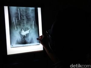 Terungkap! Ini Penyebab 48 Paku Bersarang di Perut hingga Wawan Meninggal Terungkap! Ini Penyebab 48 Paku Bersarang di Perut hingga Wawan Meninggal