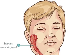 Mitos atau Fakta Belau Ampuh Atasi Gondongan? Ini Penjelasan Dokter
