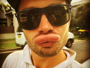 Kumpulan Selfie Menghibur dari Orang-orang yang Disengat Tawon