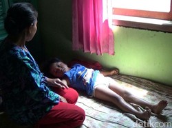 Ini Kata Dinkes Soal Bocah Tanpa Anus di Banyuwangi