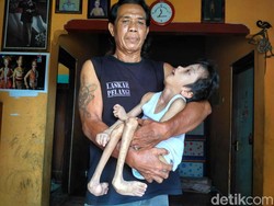Endah Safitri, Bocah Asal Pati yang Alami Kelainan Otak Sejak Bayi