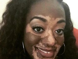 Stres Sebelum Nikah, Bercak Putih Muncul di Kulit Calon Pengantin Ini