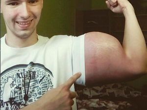 Demi Sekekar Popeye, Pria Ini Suntikkan Minyak ke Lengannya