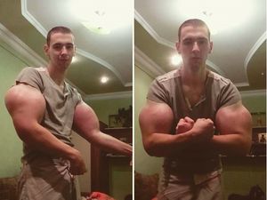 Penampakan Lengan Popeye Hasil Suntikan Minyak