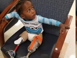 Kado Ultah Termanis Bocah yang Diamputasi Akibat Kondisi Langka