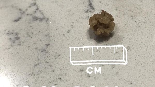 Kumpulan Penampakan Batu Ginjal, Pernah Lihat?