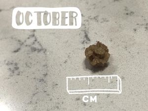 Kumpulan Penampakan Batu Ginjal, Pernah Lihat?