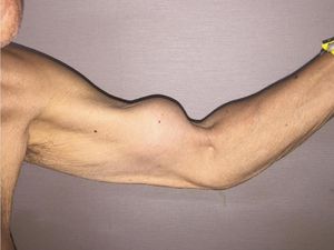 Lengan Pria Ini Jadi Besar Seperti Popeye Karena Ototnya Putus