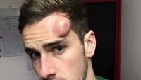 Tom Stewart mendapat benjol sangat besar di kepalanya. Cedera ini dia dapat saat memperkuat Whitehawk F.C. (divisi 6 pada level sepakbola Inggris) di ajang Piala FA. (Twitter)