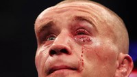 Petarung UFC, Mark Hominick, mengalami benjolan besar di kepalanya usai menjalani salah satu duelnya di kompetisi UFC. (ist.)
