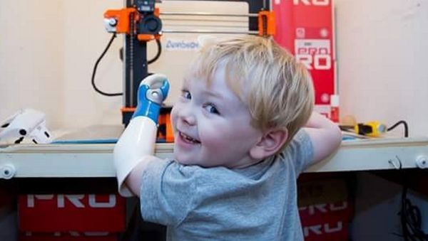 Potret Balita Bertangan Palsu yang Ceria dan Menggemaskan