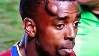 Aaron Maund mengalami benjol cukup besar pada pelipis kanannya saat dia memperkuat Real Salt Lake di ajang MLS beberapa waktu lalu. (Twitter)