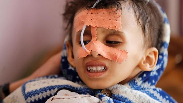 Potret Bocah-bocah Yaman yang Alami Kelaparan