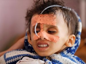 Potret Bocah-bocah Yaman yang Alami Kelaparan