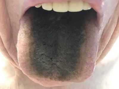 5 Hal yang Bisa Terjadi pada Lidah, Dari Berwarna Hitam hingga Retak
