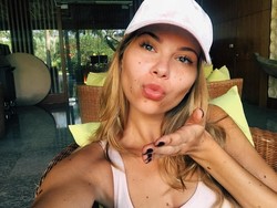 Yulianna, Gadis yang Suka Pamer Tanda Lahir di Medsos untuk Edukasi