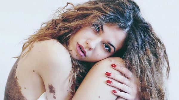 Yulianna yang Tak Malu dengan Tanda Lahir Sebadan