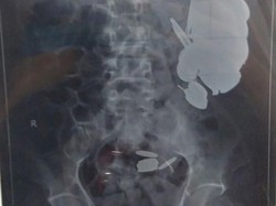 Dokter Angkat 263 Koin dan 100 Paku dari Perut Pria di India