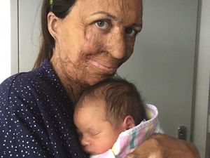 Cerita Ibu dengan Luka Bakar Saat Melahirkan Bayinya