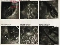 Hiii.. Wanita Ini Alami Hal Mengerikan karena 5 Tahun Tak Ganti Sarung Bantal