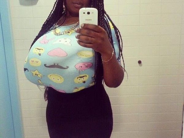 Mengaku Idap Gigantomastia, Wanita Ini Miliki Payudara Raksasa