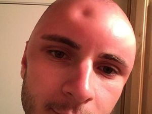 Jidat Pria Ini Penyok Gara-gara Terbakar Matahari