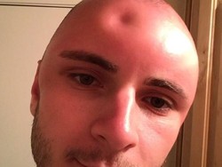 Jidat Pria Ini Penyok Gara-gara Terbakar Matahari