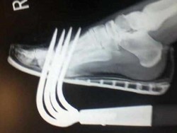 Foto Rontgen Ini Ingatkan Agar Kita Tak Sembarangan Menaruh Perkakas