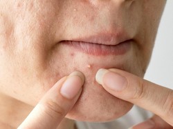 5 Makanan dan Minuman Ini Bisa Bikin Jerawat Makin Parah