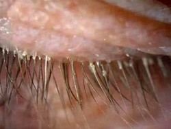Malas Cuci Seprai, Ratusan Kutu Bersemayan di Bulu Mata Wanita Ini