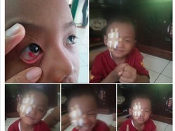 Kata Dokter Soal Perdarahan di Mata Akibat Main Gadget