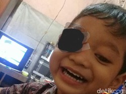 Rizwan, Bocah 3 Tahun di Kudus Idap Tumor Mata Sebesar Bola Tenis
