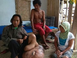 Kasihan, Warga Banyuwangi Ini Punya Benjolan di Kaki Seberat 60 Kg