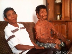 Tubuh Dipenuhi Benjolan, Bethu akan Dibantu Pengobatan